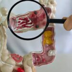 Em 13 anos, doença inflamatória intestinal cresce 5 vezes no Brasil